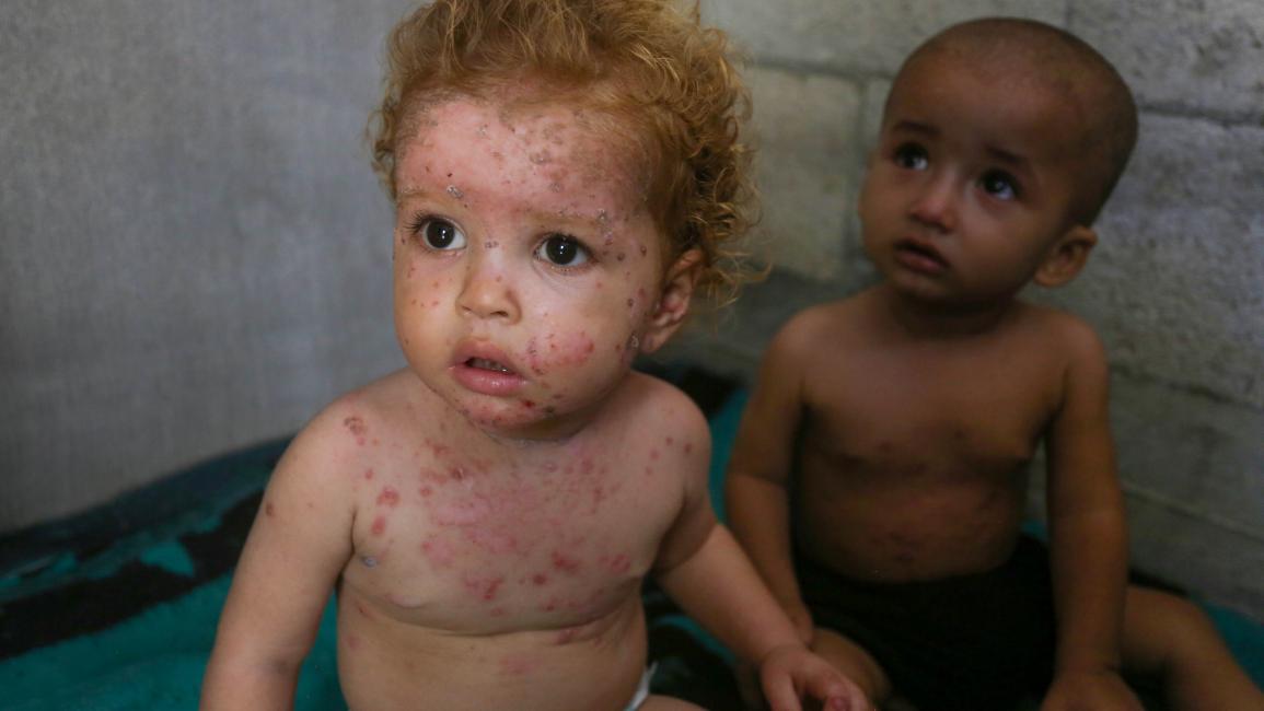 الأمراض الجلدية تفتك بالأطفال (أشرف أبو عمرة/ الأناضول)