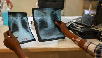 صور أشعة لمريض مصاب بالسل في الهند (بونيت بارانجبيه/ فرانس برس)