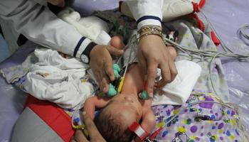 سوء التغذية يهدد حياة أطفال غزة (محمود عيسى/ الأناضول)